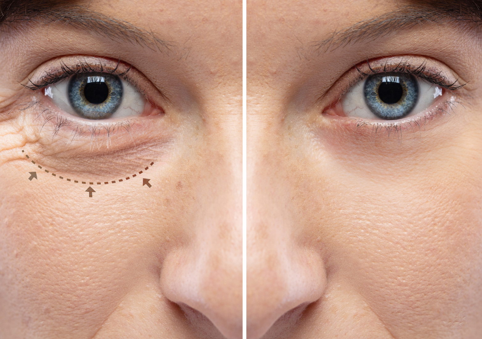 blefaroplastia-tres-lagoas.webp